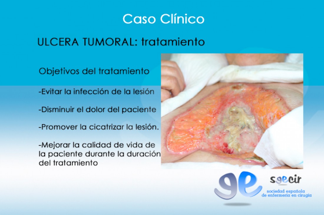 CraUlceraTumoral-08