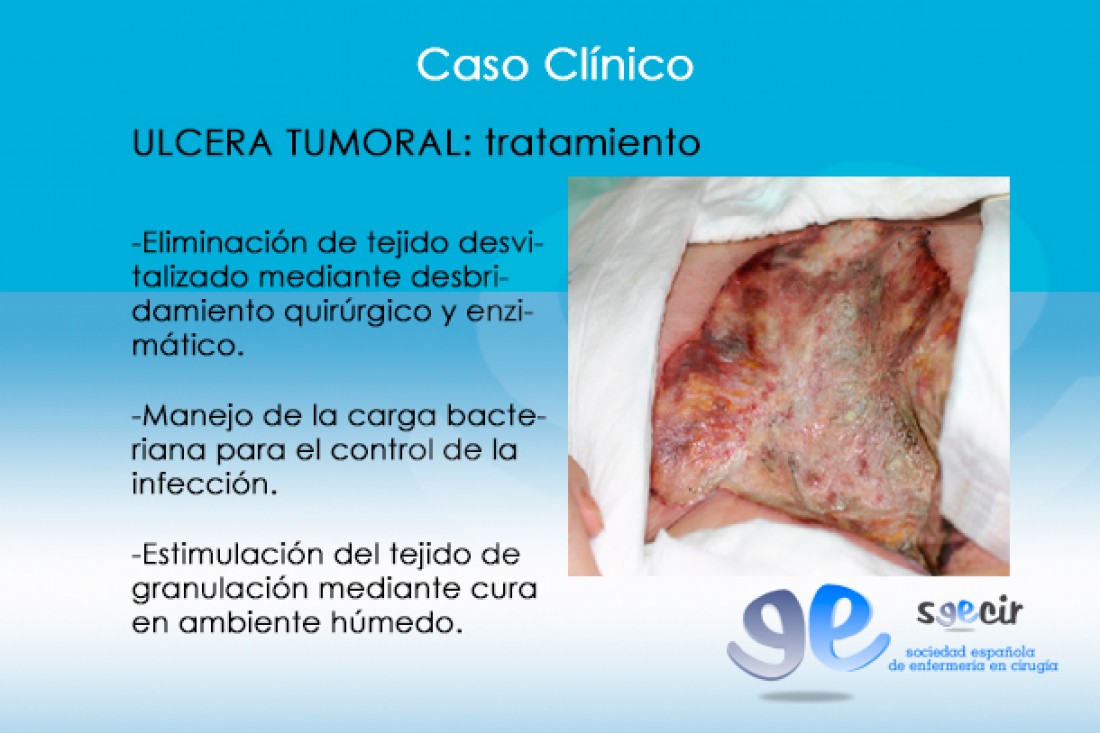 CraUlceraTumoral-09