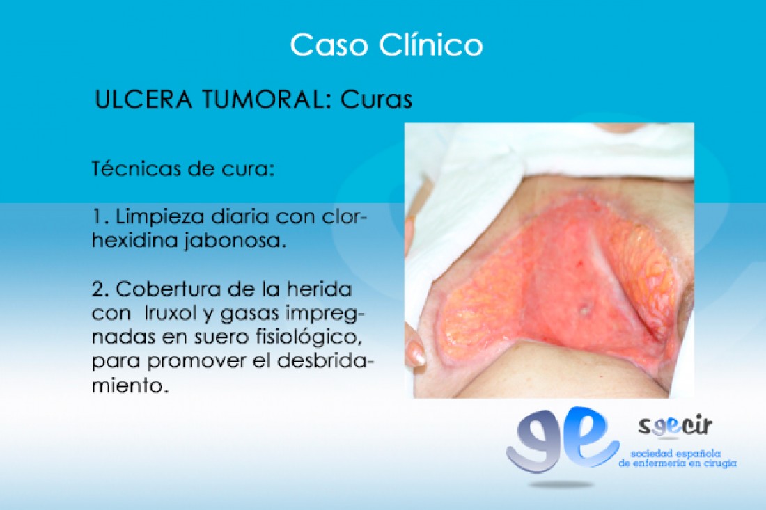 CraUlceraTumoral-10
