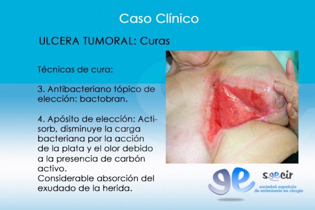 CraUlceraTumoral-11