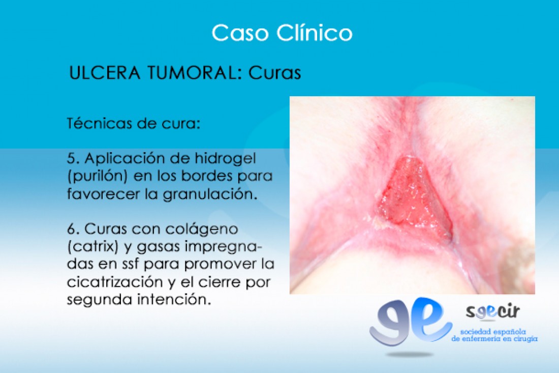 CraUlceraTumoral-12