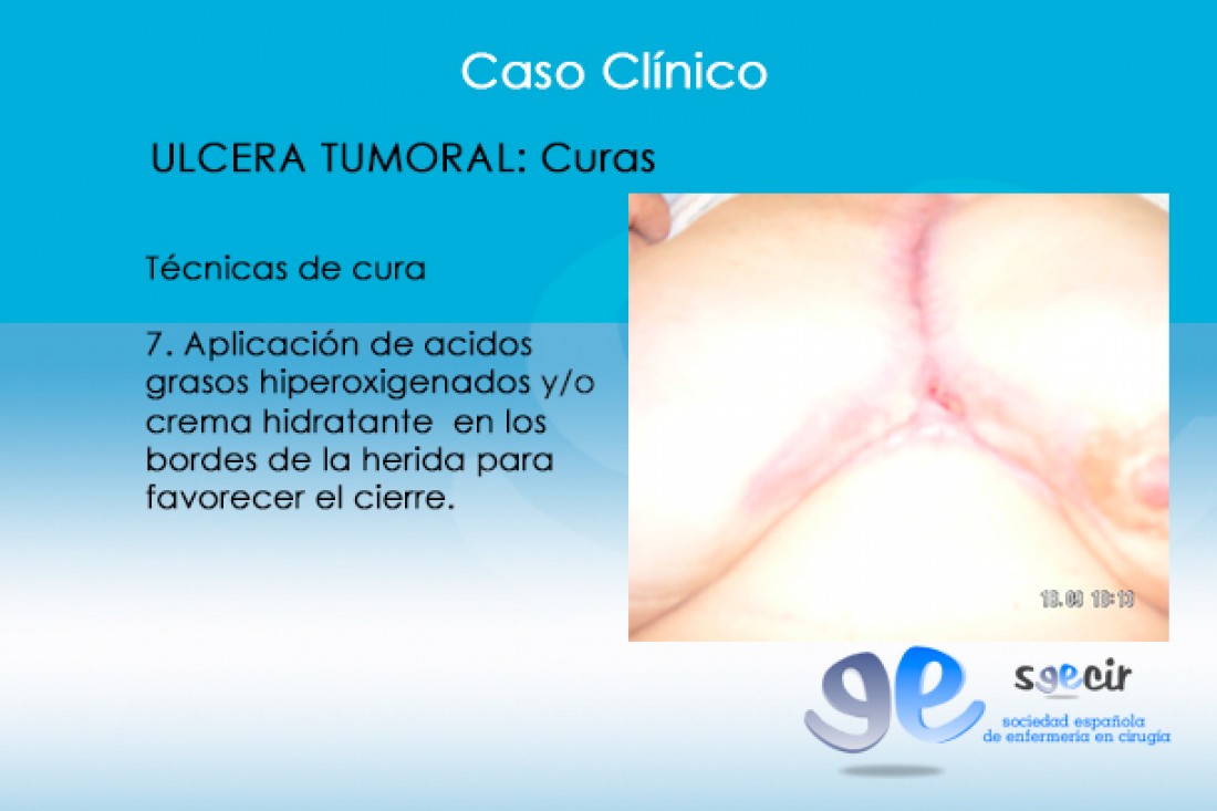 CraUlceraTumoral-13